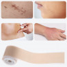 Silicone band scar reduction
